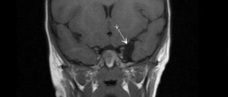 Арахноидальная киста (указана стрелкой) на МР-скане