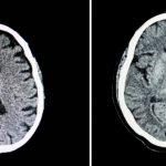 атрофия мозга и здоровый мозг
