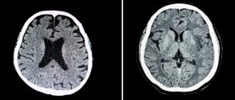 brain atrophy and healthy brain