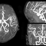 МРТ-снимок сосудов головного мозга ребенка