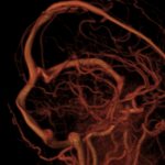 МРТ сосудов головы в 3D