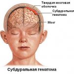 Субдуральная гематома головного мозга