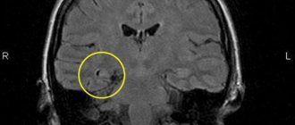 Височный склероз на МРТ головного мозга